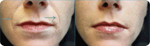 Dermal Skin Filler Results