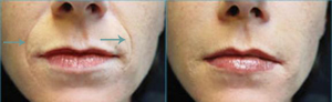 Dermal filler results