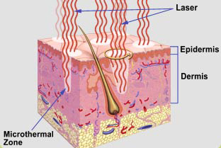 Laser Tightening Theory