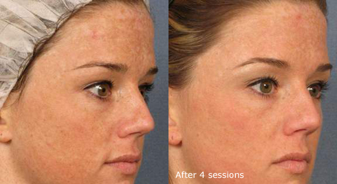 Laser skin rejuvenation results