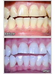 Teeth Bleaching Treatment Results